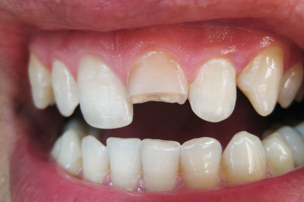 Tooth prepared for dental crown